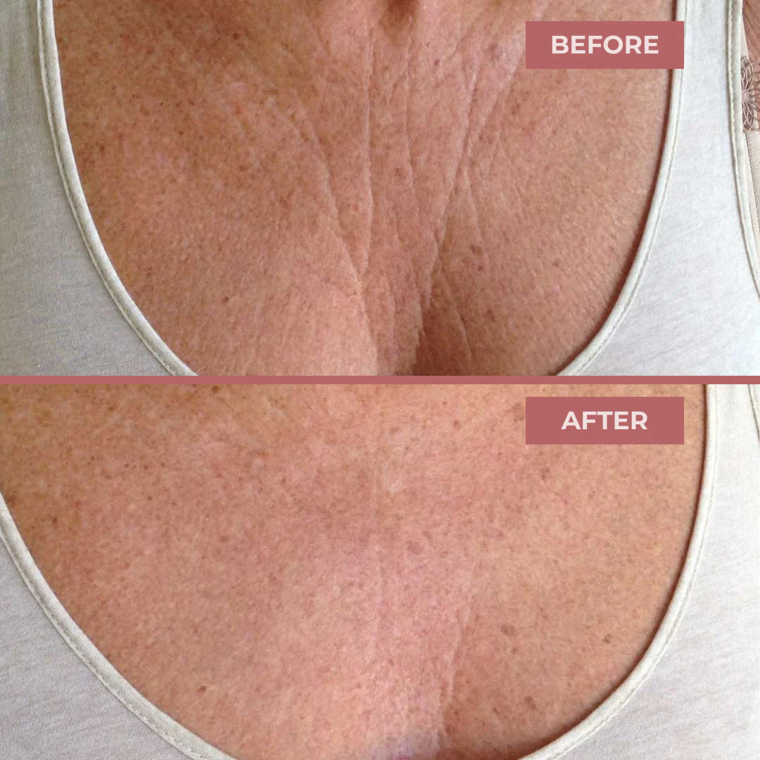 Bio-Collagen Chest Patches - Image 7