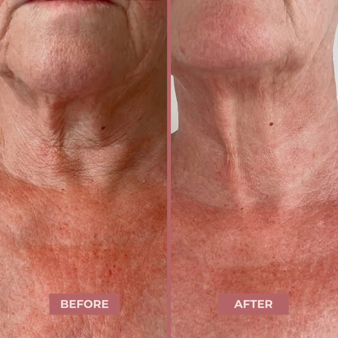 BioCollagen Neck Patches - Image 7